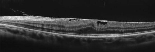 黄斑前膜の光干渉断層計の写真