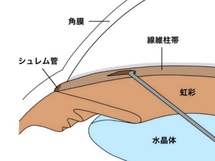 線維柱帯切開術